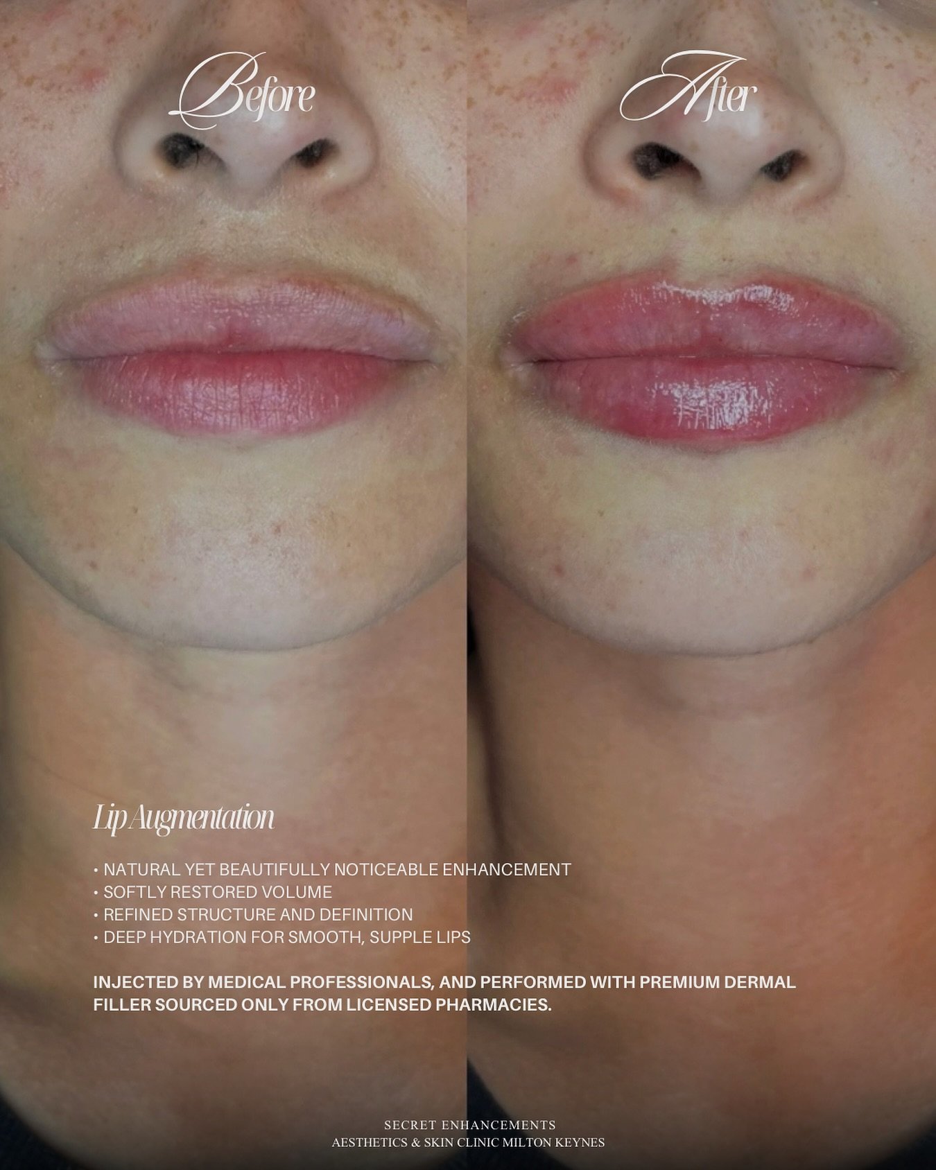 Lip Filler Result ✨

A refined enhancement designed to restore balance, softness and natural definition.

At Secret Enhancements, Milton Keynes, our approach to lip filler is subtle, bespoke and led by facial harmony.

Carefully placed dermal filler 