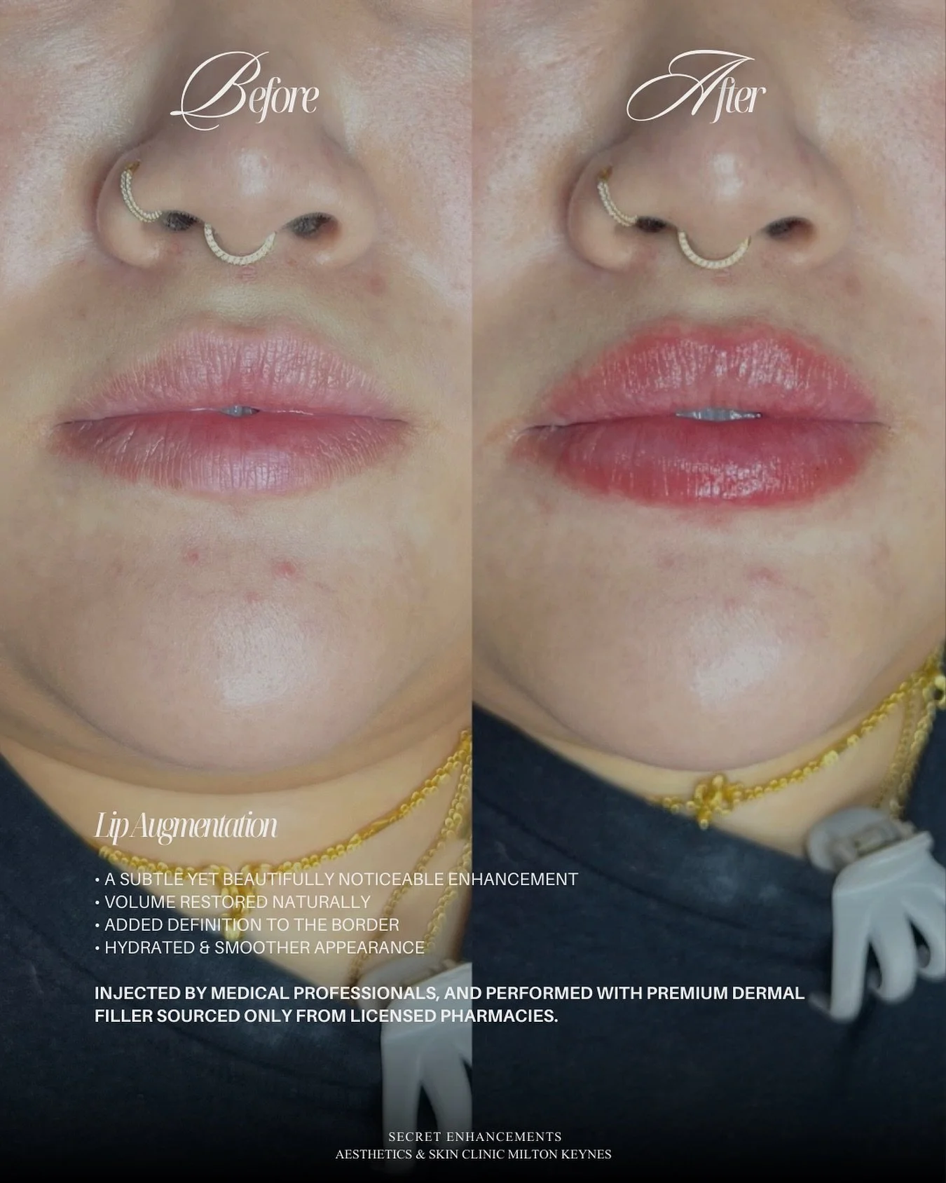 Lip Filler Result ✨

A refined enhancement designed to restore balance, softness and natural definition.

At Secret Enhancements, Milton Keynes, our approach to lip filler is subtle, bespoke and led by facial harmony.

Carefully placed dermal filler 