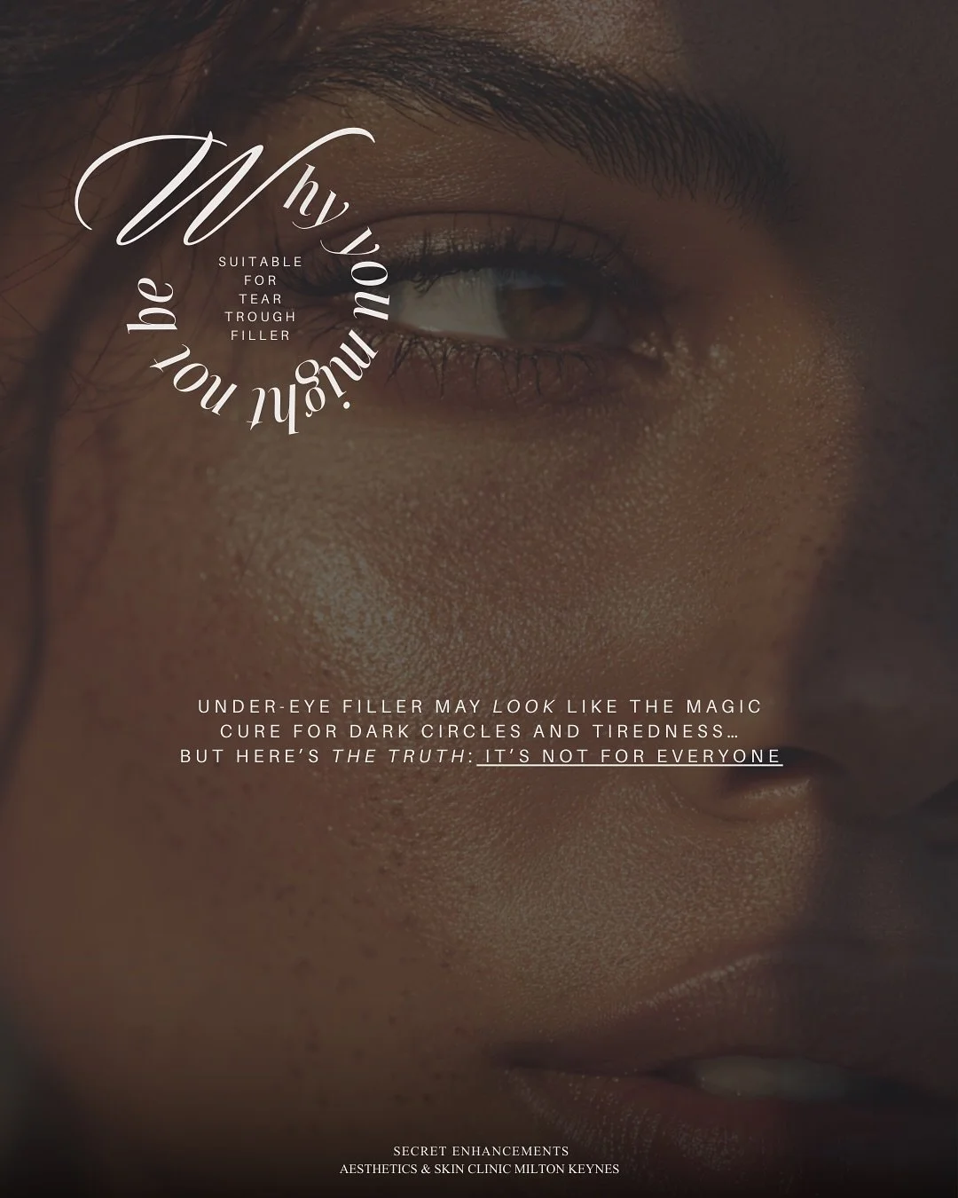 Tear Trough Filler: Is It Always the Right Choice? ✨

Tear trough filler can be a beautiful solution for the right candidate, but it isn&rsquo;t suitable for everyone. 

At Secret Enhancements, Milton Keynes, our priority is always safety, facial har