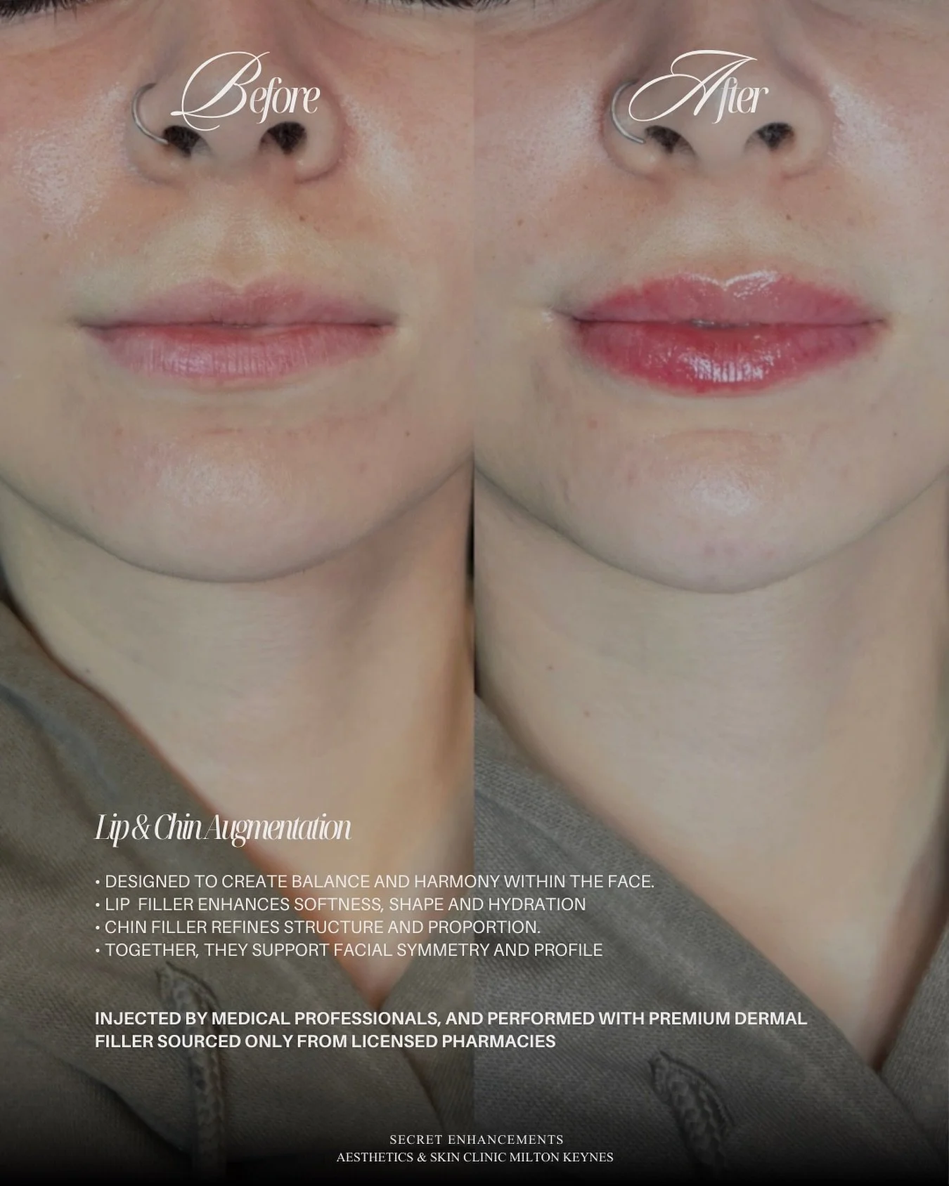 Lip &amp; Chin Filler Result ✨

A refined combination designed to enhance facial balance, structure and harmony. 

At Secret Enhancements, Milton Keynes, lip and chin filler treatments are carefully tailored to support natural proportions, enhancing 