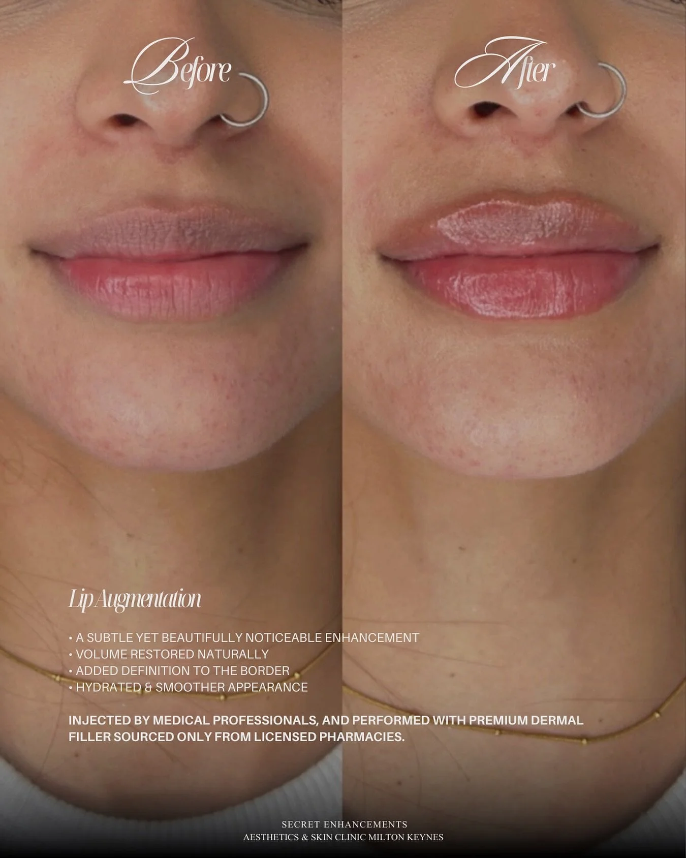 Lip Filler Result by Nurse Mollie ✨

Refined definition, balanced proportions and beautifully natural volume. 

Nurse Mollie uses Camille&rsquo;s signature approach focuses on subtle enhancement, creating lips that are softly structured, hydrated and