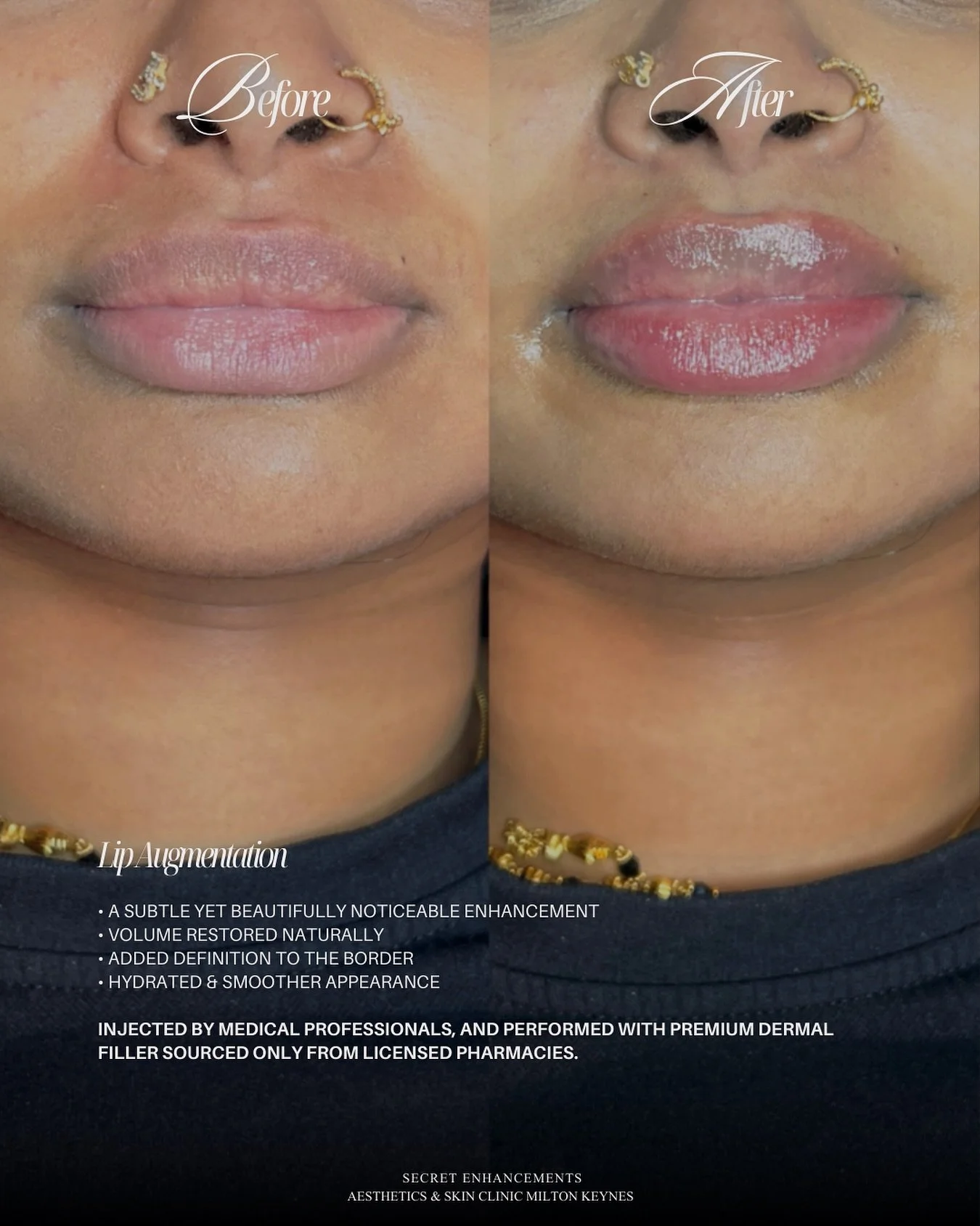Lip Filler Result ✨

Subtle enhancement, refined definition, and beautifully balanced proportions. 

At Secret Enhancements, Milton Keynes, our lip filler treatments are designed to complement your natural features. 

Enhancing shape, structure and h