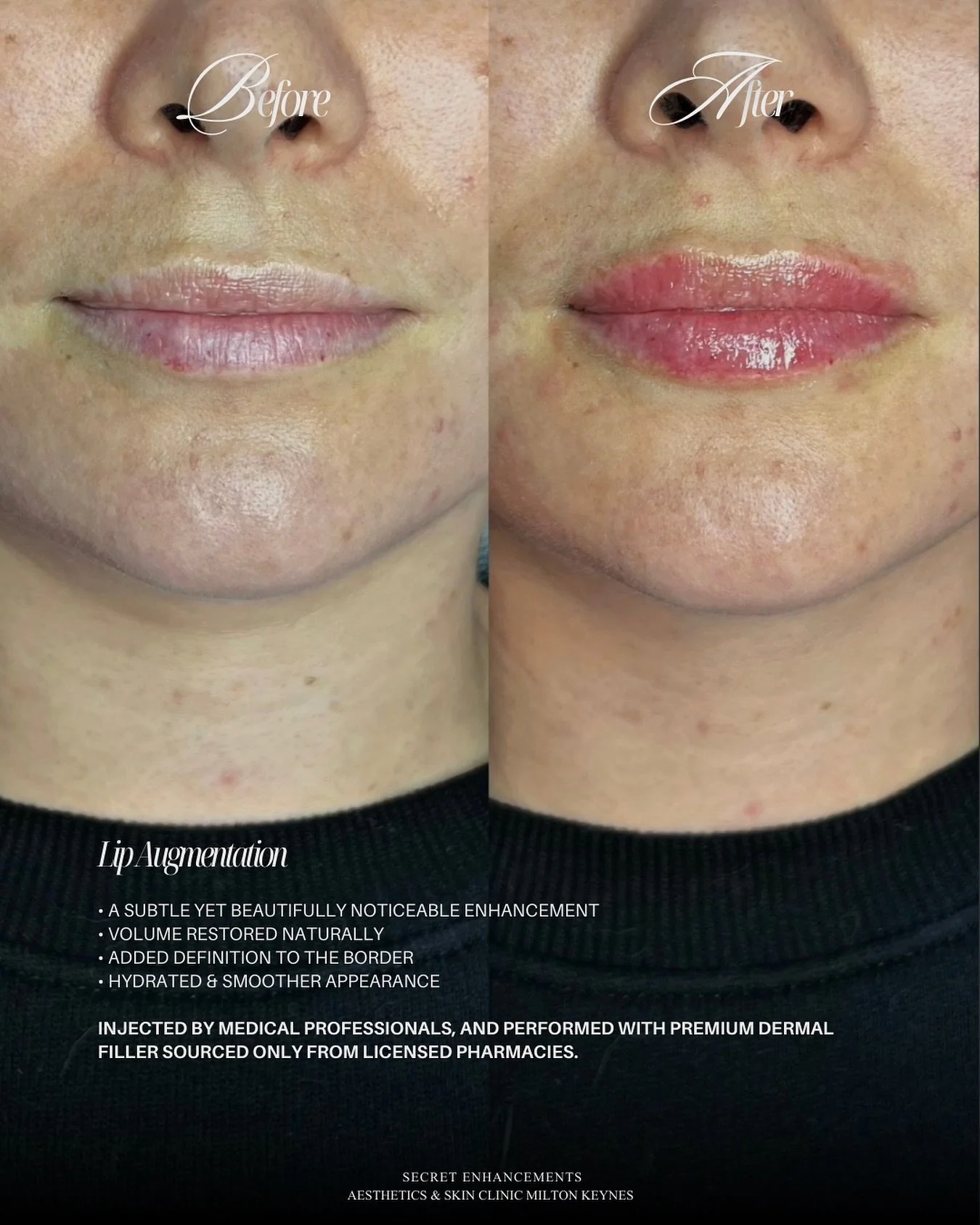Lip Filler Result ✨

A refined enhancement designed to restore balance, softness and natural definition.

At Secret Enhancements, Milton Keynes, our approach to lip filler is subtle, bespoke and led by facial harmony.

Carefully placed dermal filler 