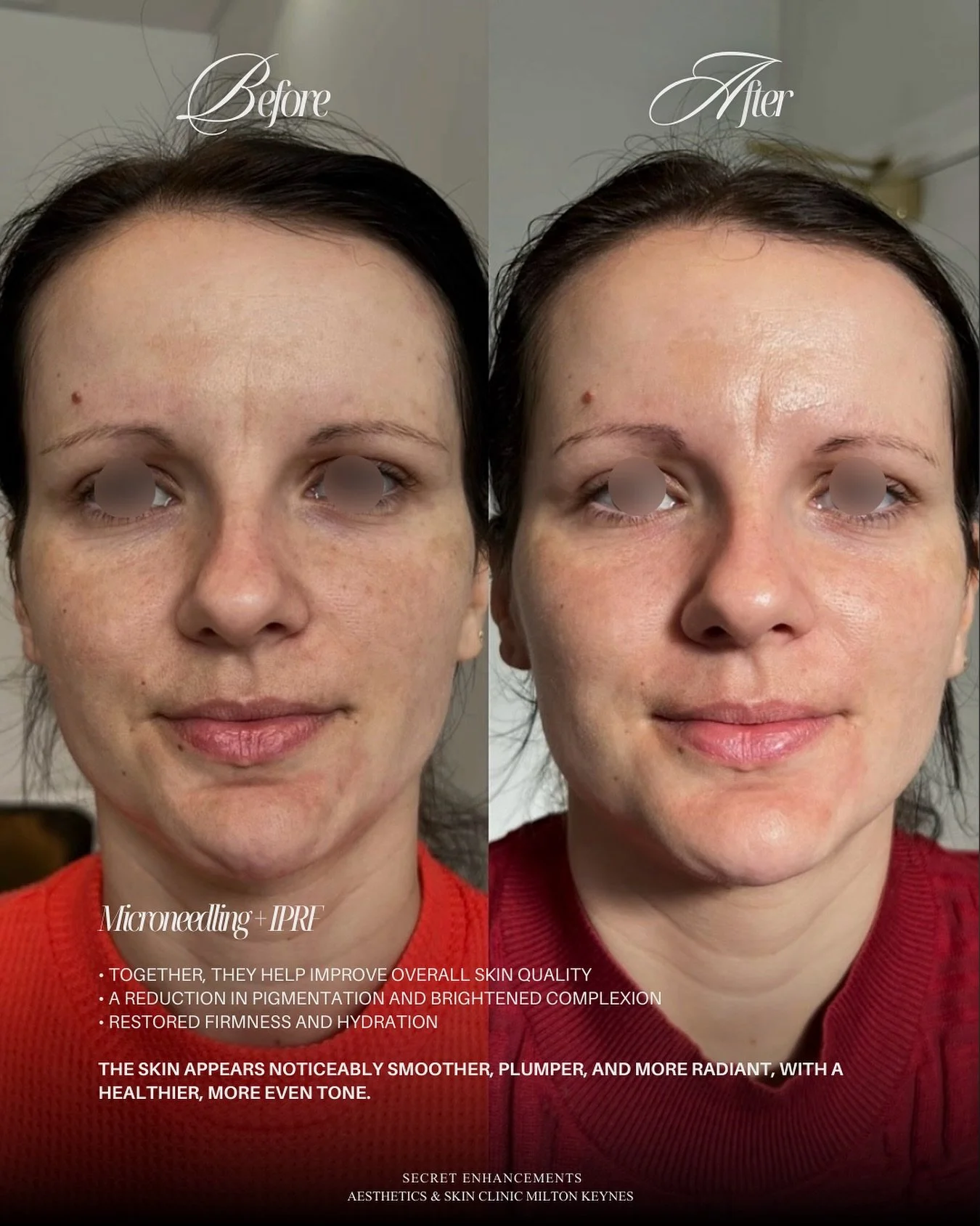 iPRF + Microneedling Result ✨

One of our most popular skin treatments at Secret Enhancements, Milton Keynes and a favourite for those looking to improve overall skin quality.

Microneedling creates controlled micro-channels to stimulate collagen and