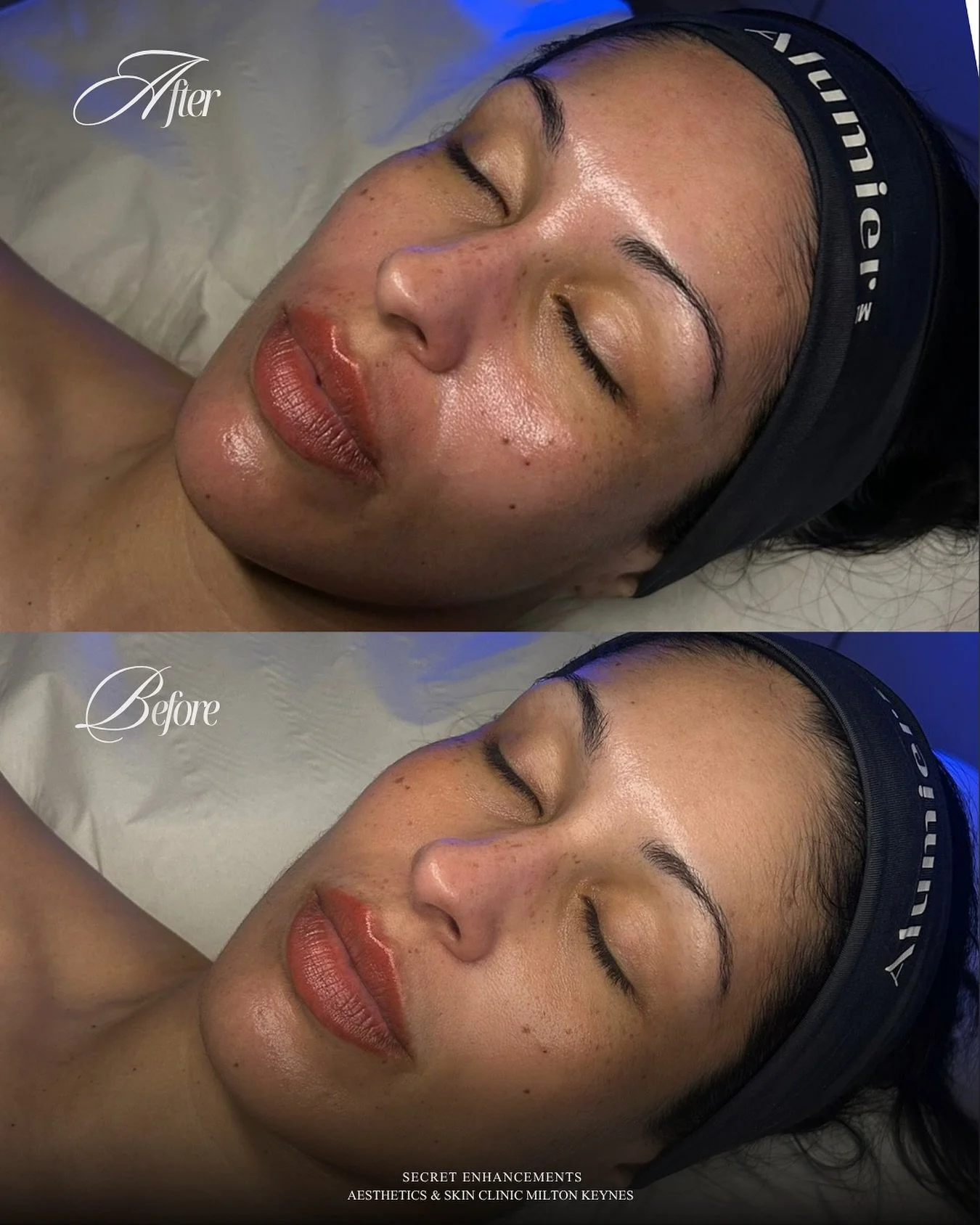 Radiant 30 Chemical Peel Result ✨

The AlumierMD Radiant 30 Peel is a powerful yet gentle chemical peel designed to improve skin clarity, texture and overall radiance. 

Using 30% lactic acid, this advanced peel works to exfoliate the skin, unclog po
