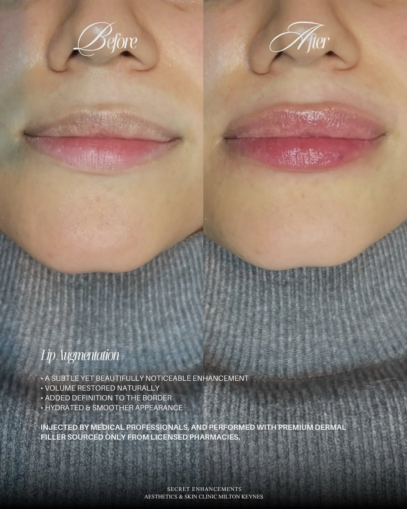 Lip Filler Result ✨

A refined enhancement designed to restore balance, softness and natural definition.

At Secret Enhancements, Milton Keynes, our approach to lip filler is subtle, bespoke and led by facial harmony.

Carefully placed dermal filler 
