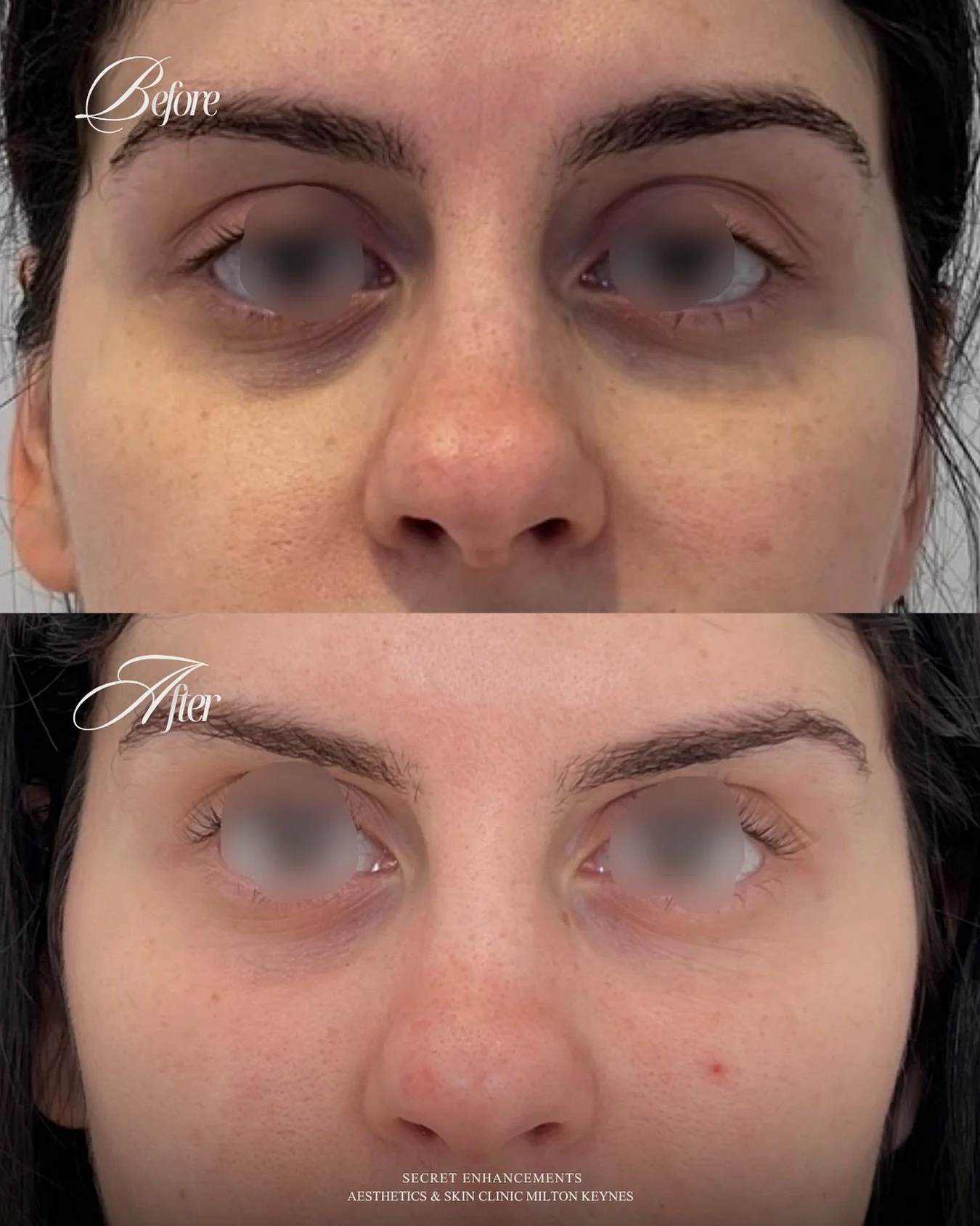 Polynucleotides Under-Eye Result ✨

A refined, regenerative approach to under-eye rejuvenation at Secret Enhancements, Milton Keynes.

Polynucleotides work by stimulating cellular repair, improving skin quality and strengthening the delicate under-ey