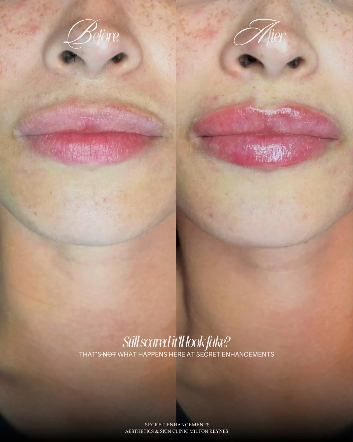 Less is more, and this proves it. 💉

This is what we mean when we say natural lip filler. No duck lips. No obvious &lsquo;done&rsquo; look. Just beautifully balanced, softly enhanced lips that look like they were always meant to look this way. 😍

A