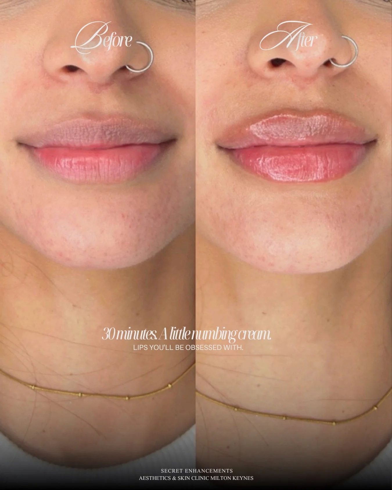 Before &rarr; After. And she is OBSESSED!

This is what happens when lip filler is done right. ✨

No overfilling. No guesswork. Just a beautifully natural enhancement that works with her unique lip shape to create more definition, a softer cupid&rsqu