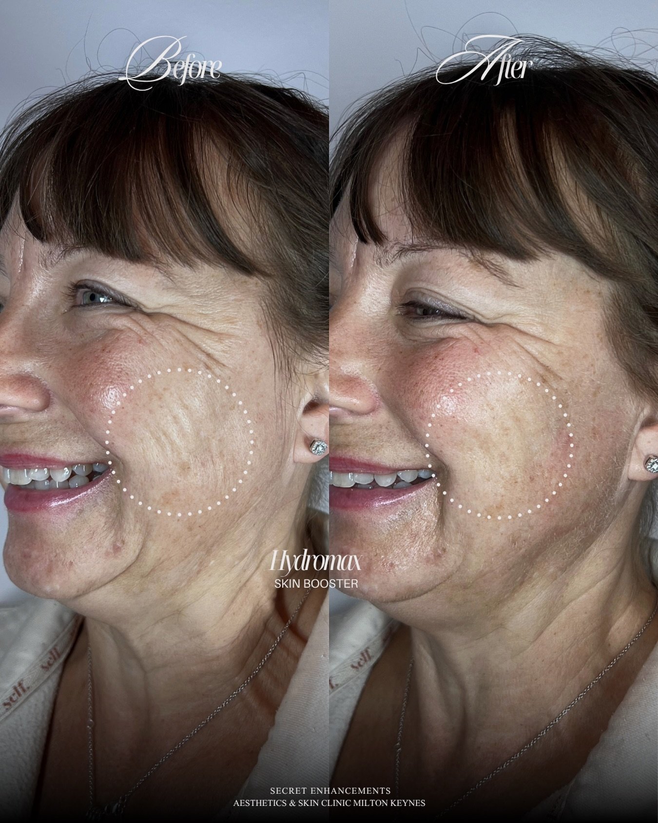 See those lines around the corners of her mouth when she smiles? 👀

They&rsquo;re called Accordion Lines&hellip; and Hydromax just changed the game for them!

Accordion lines are those fine, vertical crinkly lines that fan out from the outer corners