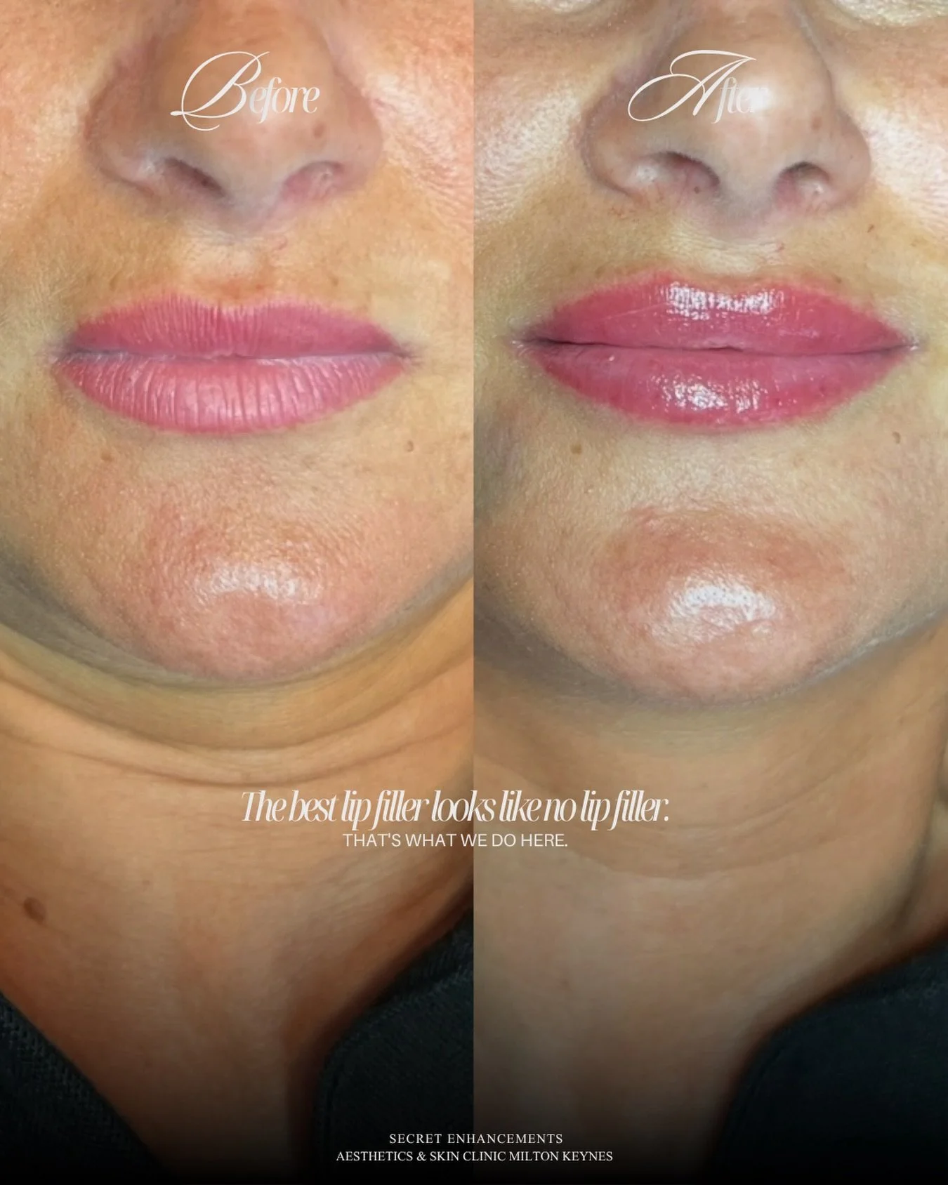Lip filler is our most popular treatment. And results like this are exactly why!

We could talk all day about technique, product quality and personalised placement. 

But honestly? We&rsquo;ll let this speak for itself. 👆

What we will say is this&h