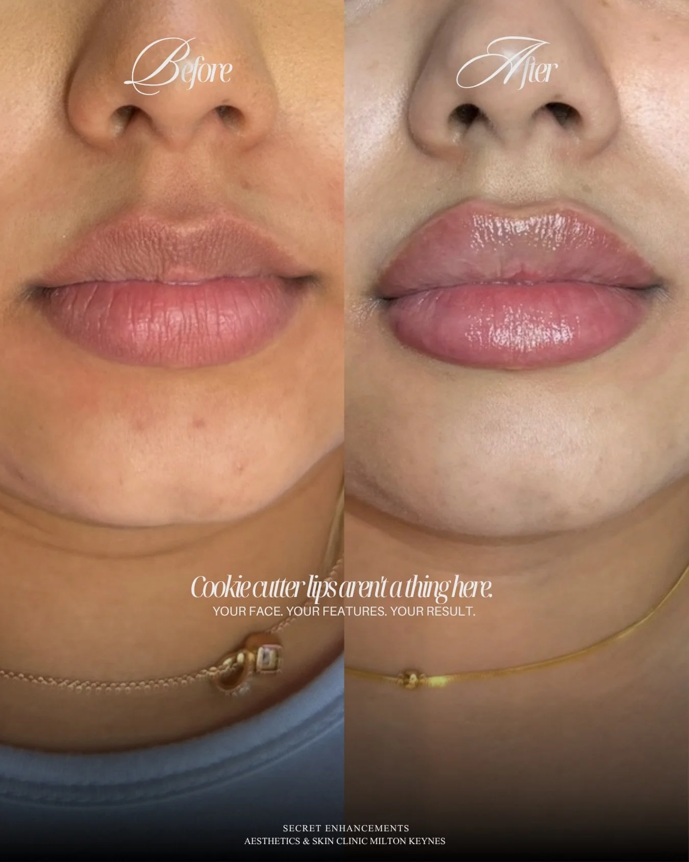 This is the result that says everything without saying a word. 

No drama. No exaggeration. No &lsquo;you can really tell she&rsquo;s had something done.&rsquo;

Just lips that look absolutely, effortlessly perfect. ✨

And honestly? 

That&rsquo;s th