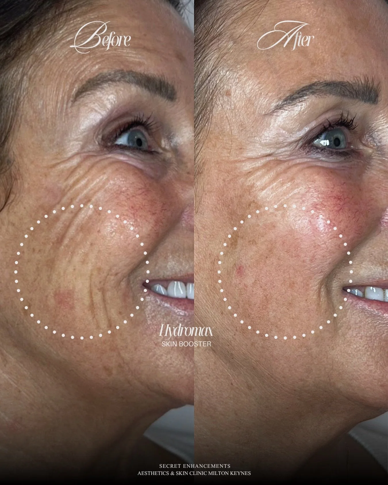 We keep saying it. And results like this keep proving us right. 👆

Hydromax is the treatment everyone needs to try. ✨

Look at those accordion lines. Those deep, vertical creases that form around the corners of the mouth when you smile, the ones tha