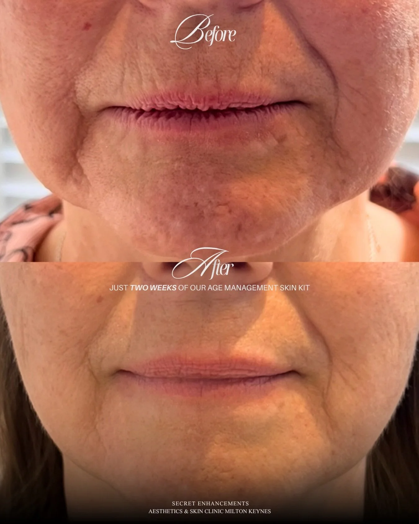 Two weeks. Zero treatments. Just the kit. 👆

This is what two weeks of our pH Formula Age Management Kit did for this client&rsquo;s perioral area, the fine lines around the mouth that are often one of the first and most stubborn signs of ageing to 