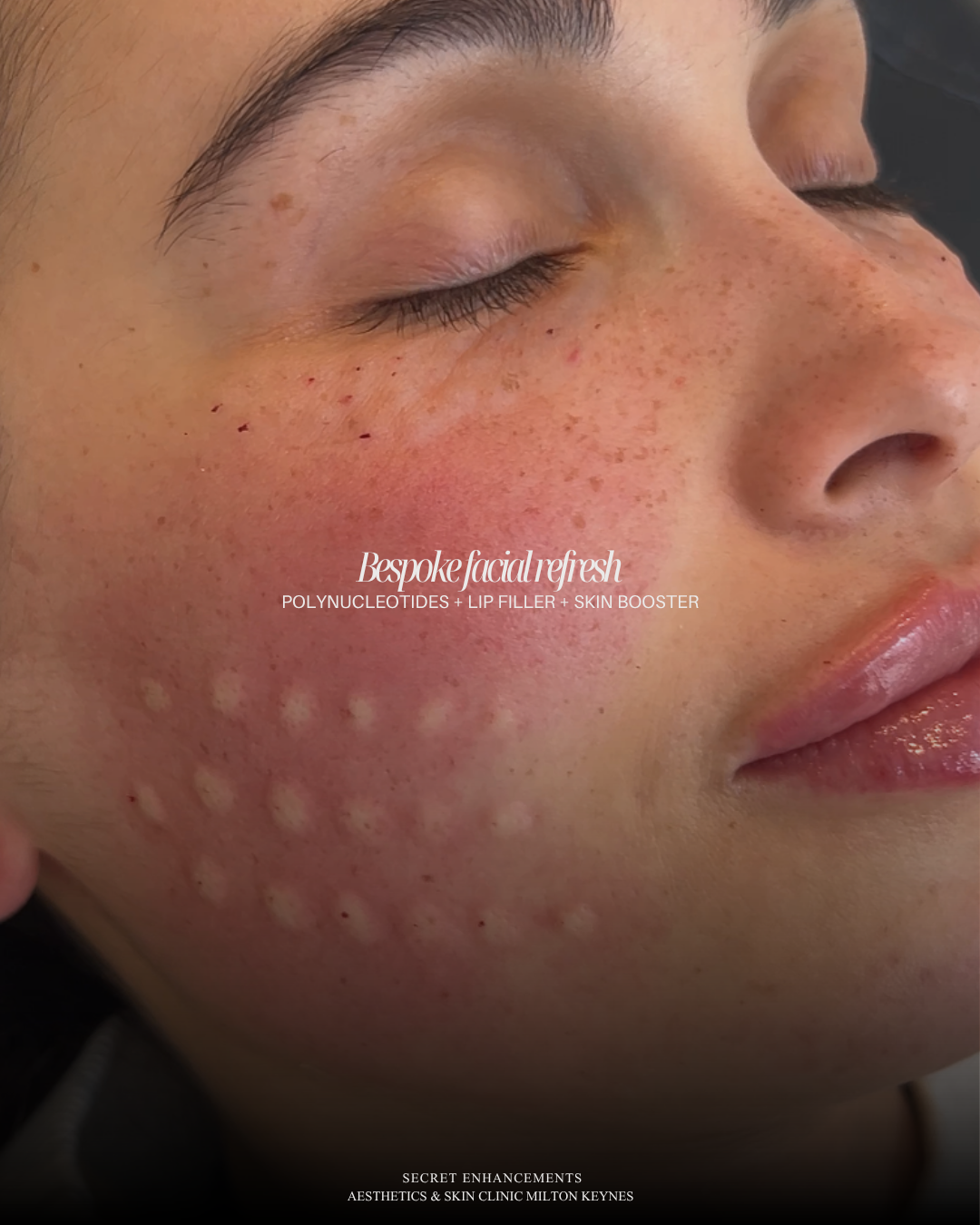 Can You Combine Treatments? How Fillers, Chemical Peels and Microneedling Work Together