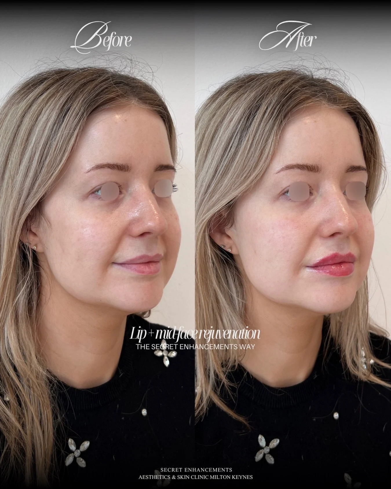 This is what a full facial refresh actually looks like. 👆

Lips AND midface. Together. And the difference is everything. ✨

This is the transformation that happens when you stop treating areas in isolation and look at the face as a whole. The midfac