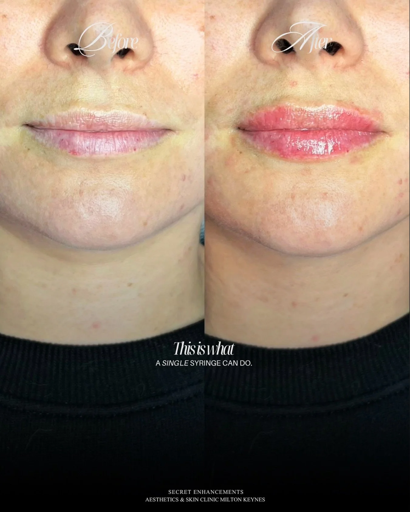 Lip Filler Result ✨

A refined enhancement designed to restore balance, softness and natural definition.

At Secret Enhancements, Milton Keynes, our approach to lip filler is subtle, bespoke and led by facial harmony.

Carefully placed dermal filler 