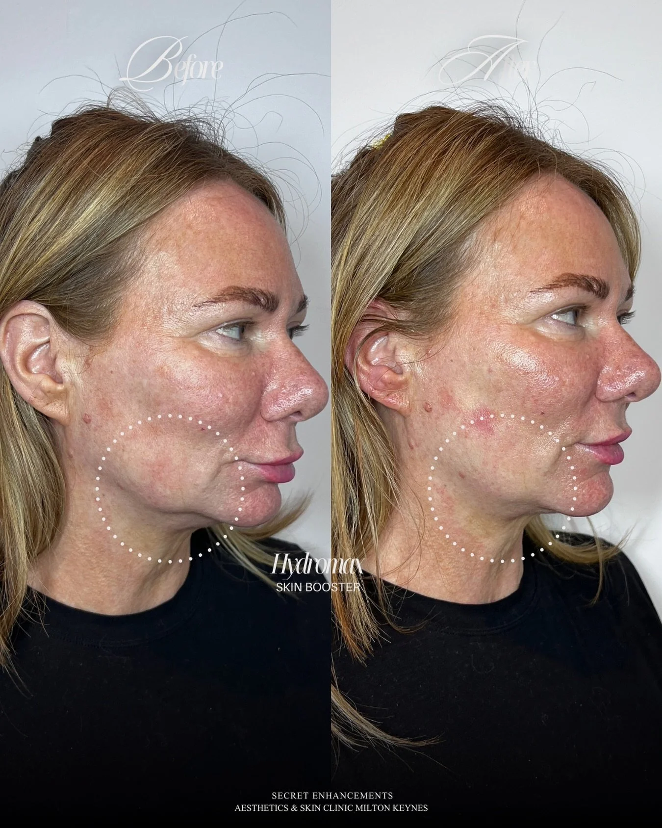See those jowls? See the corners of that mouth pulling down? 

Look again. 👆

Because Hydromax just changed everything. ✨

This is one of those results that stops us mid-scroll every single time. The sides of the mouth, lifted. The jowls, visibly re