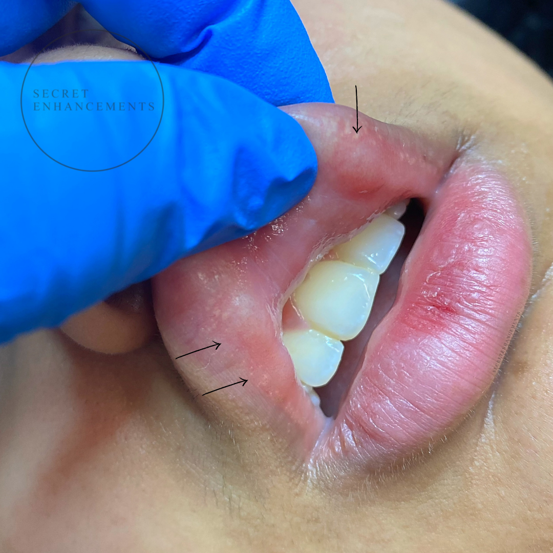 Close-up of a person's mouth showing teeth and lips, with a medical glove and annotations pointing to the upper lip and lower gums.