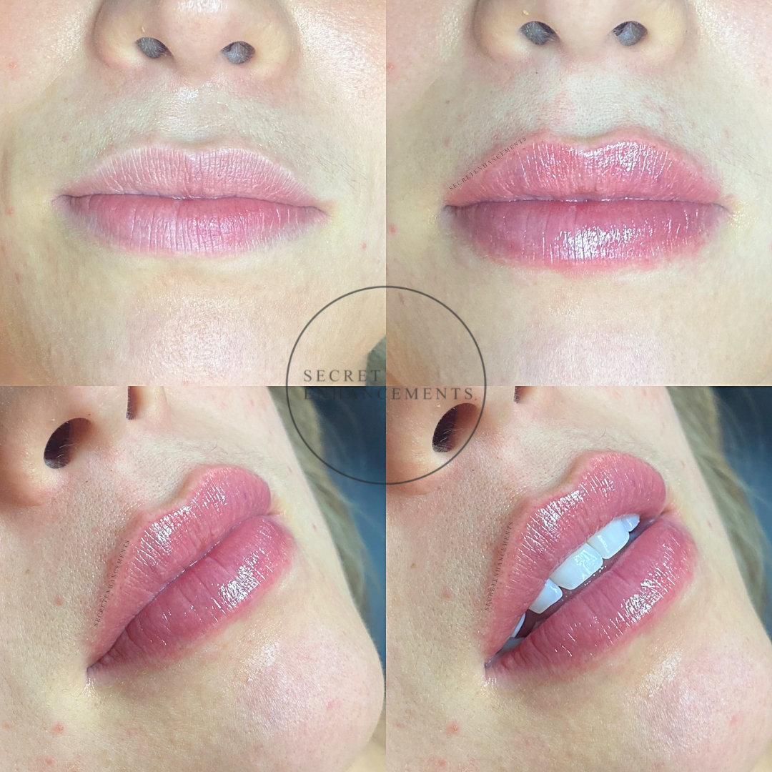Close-up of a woman's lips before and after lip enhancement, showing fuller, glossier lips with a natural pink tone.