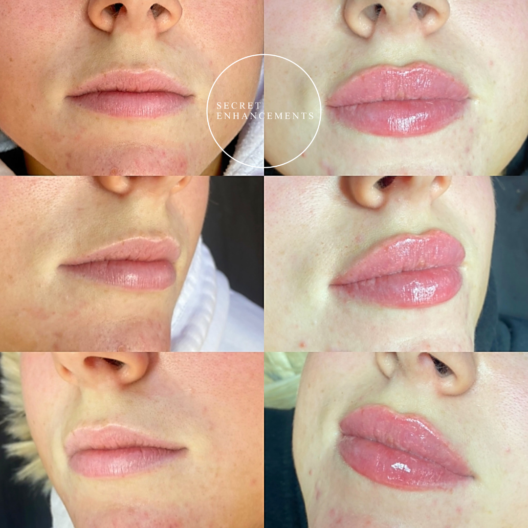 A collage showing the before and after results of lip enhancement. The top row displays lips before enhancement, and the bottom row shows lips after enhancement with added gloss and fullness.