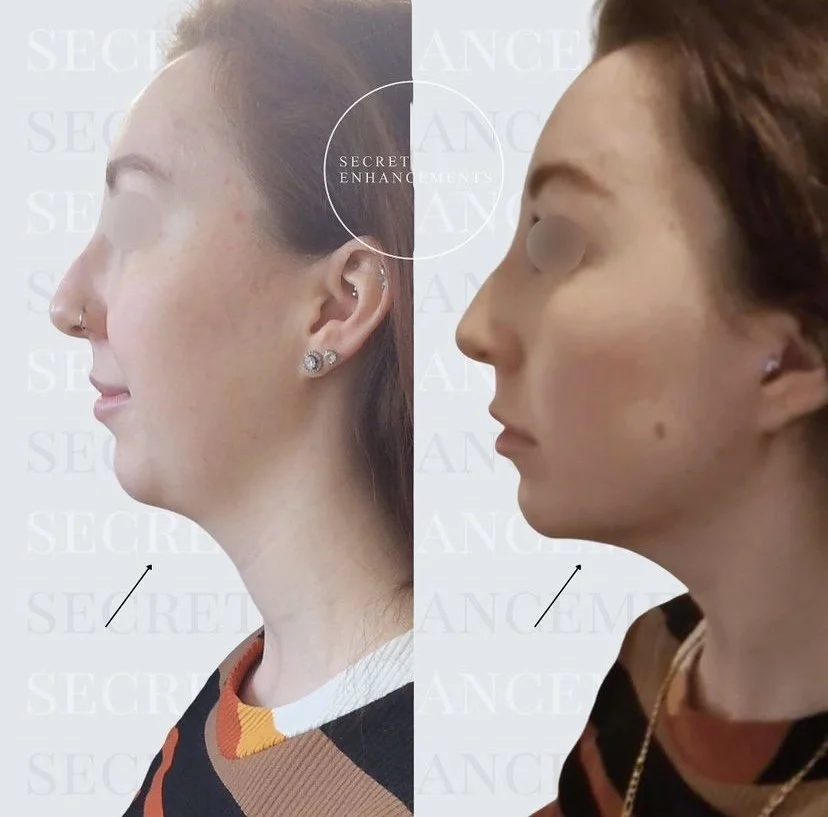 fat dissolving chin