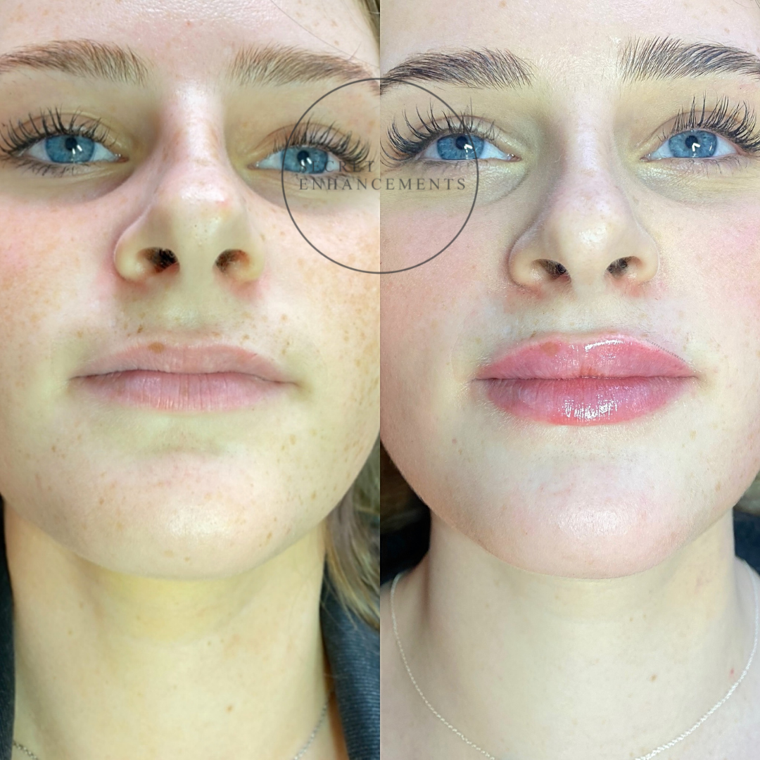 Side-by-side comparison of a woman before and after cosmetic lip and eyebrow enhancements, showing fuller lips and more defined eyebrows in the after photo.