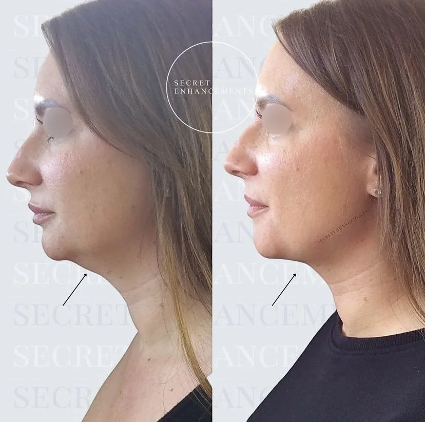 fat dissolving chin