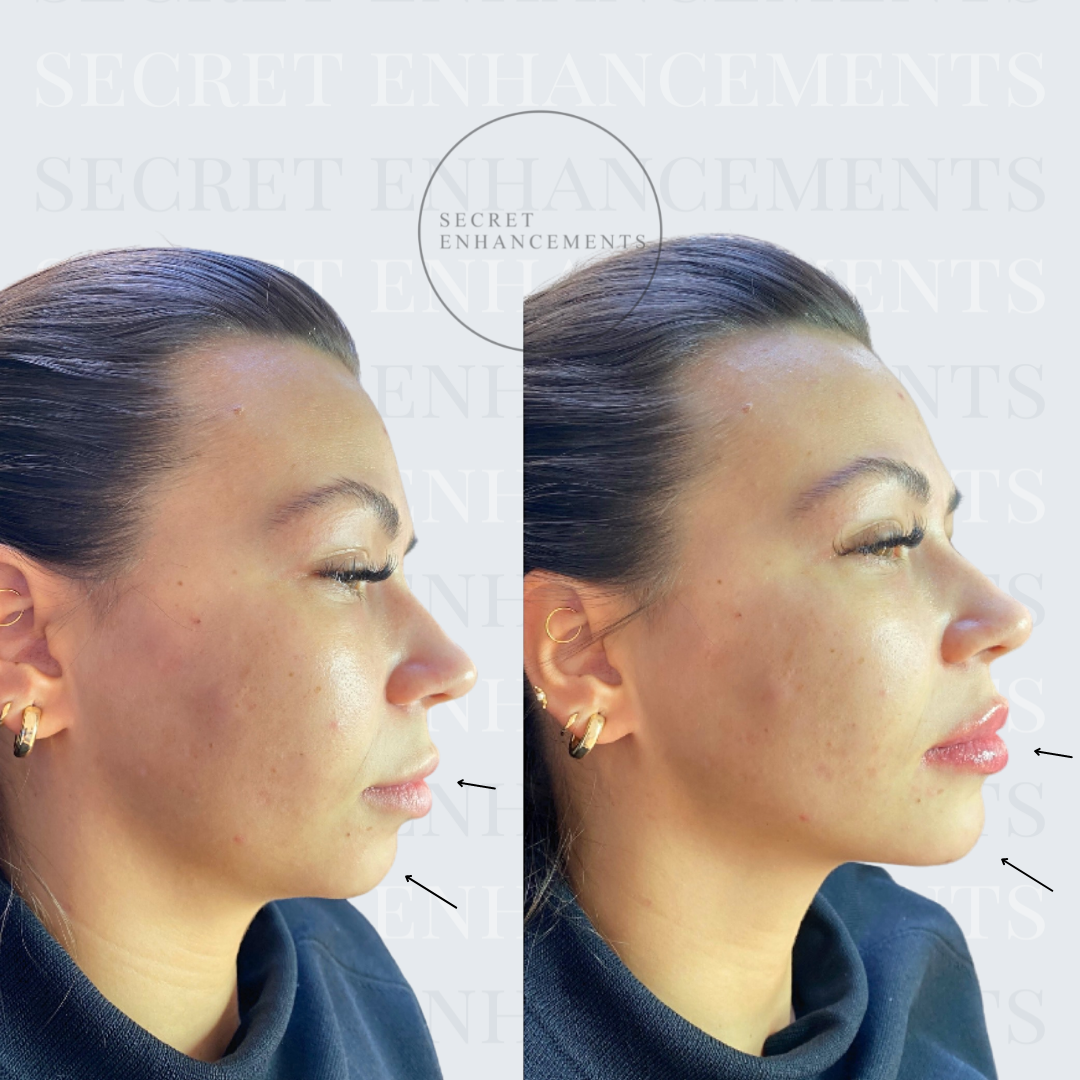 chin augmentation Milton Keynes