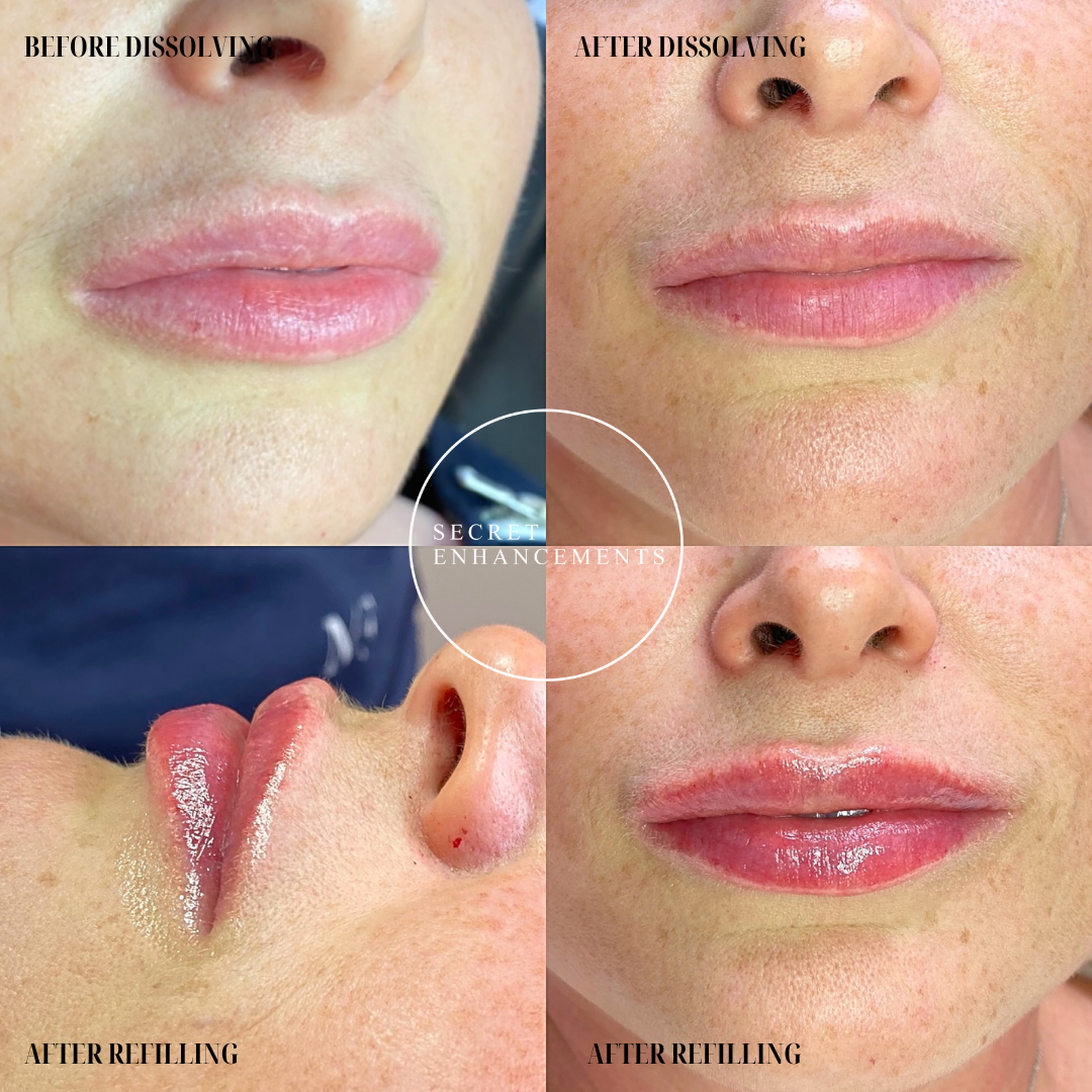 A collage showing a person's lips before and after lip dissolving and refilling. Top left: lips before dissolving, top right: lips after dissolving, bottom left: lips after refilling, bottom right: lips after refilling.