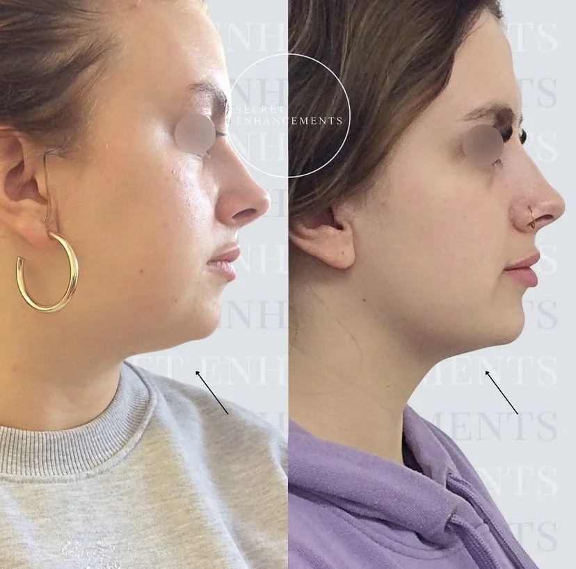 fat dissolving chin