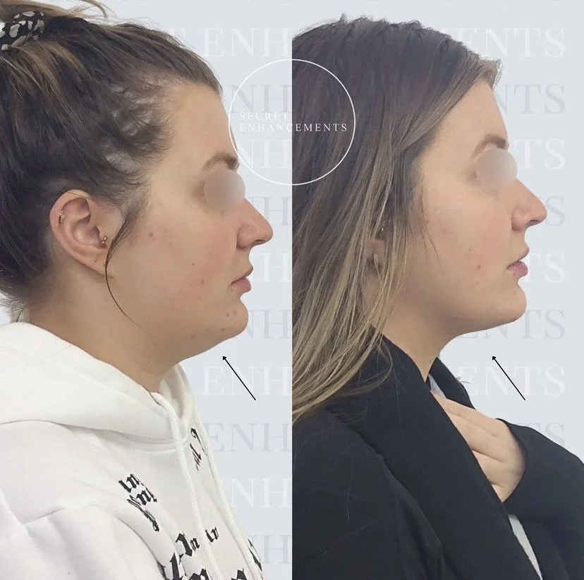 fat dissolving chin