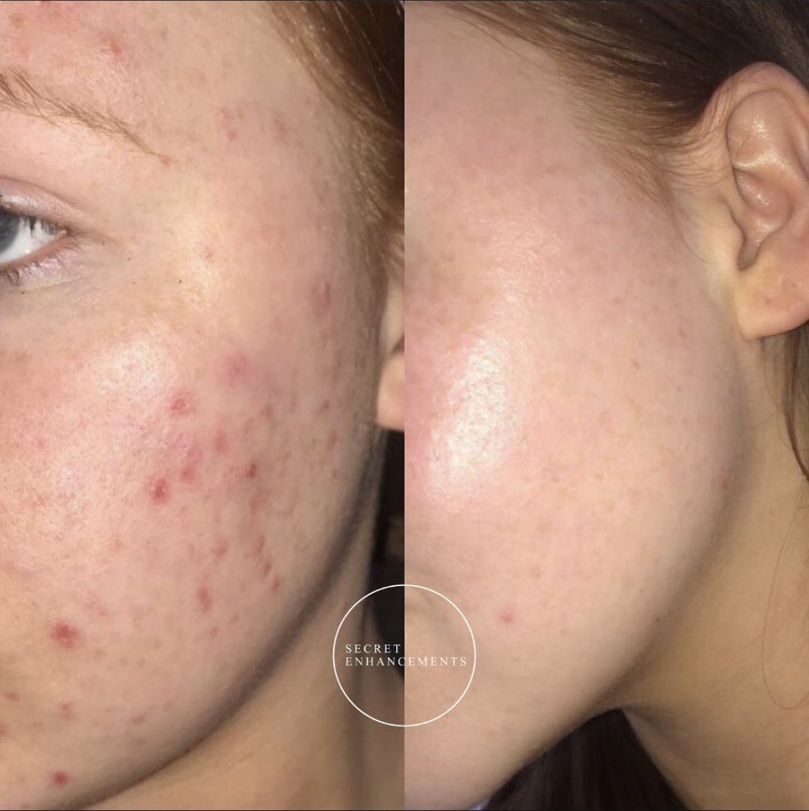 Before and after skincare treatment for acne-prone skin at a Milton Keynes skin clinic. Visible improvement in skin clarity, redness, and texture.