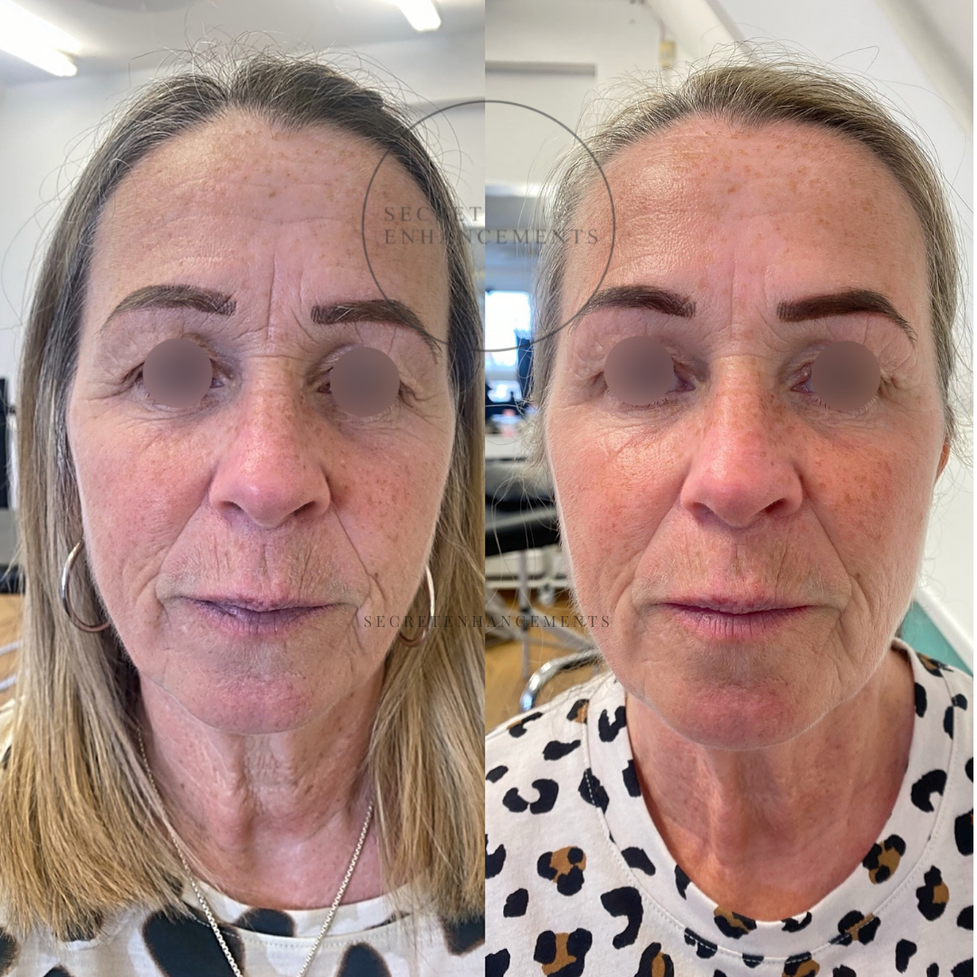 profhilo skin plumping anti ageing treatment
