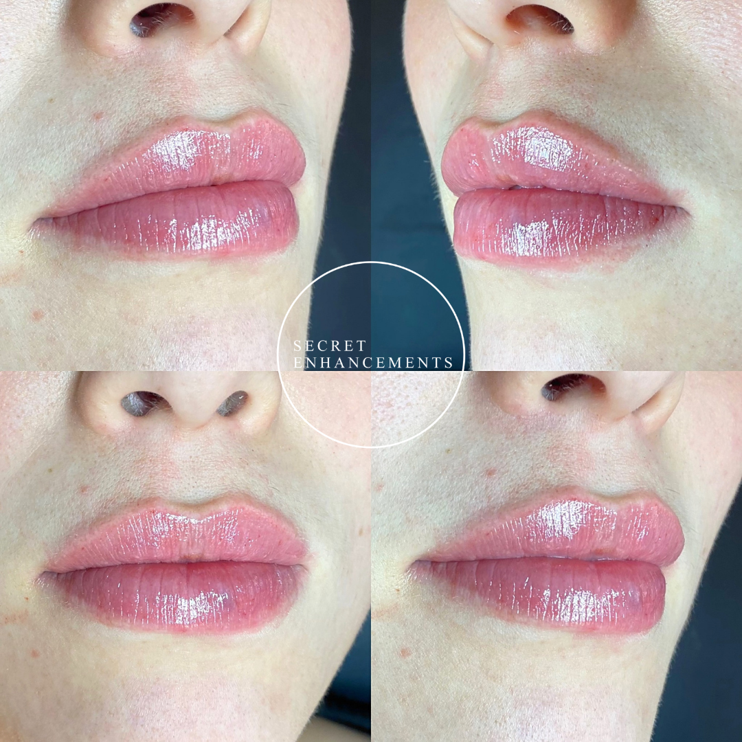 lip enhancement Milton Keynes