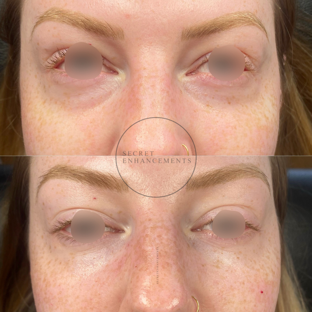 tear trough filler Milton Keynes