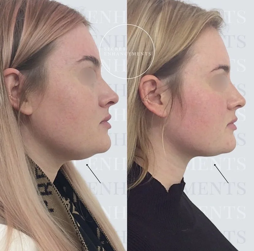 fat dissolving chin