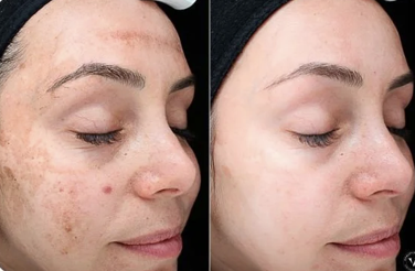 Chemical Peels with Dewy