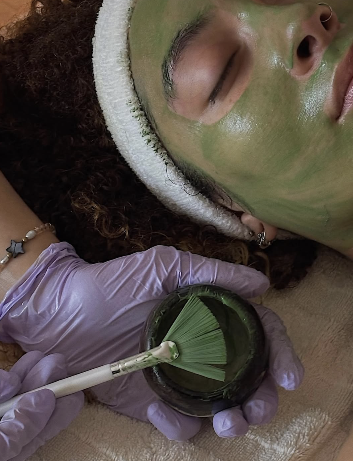 Hyperpigmentation