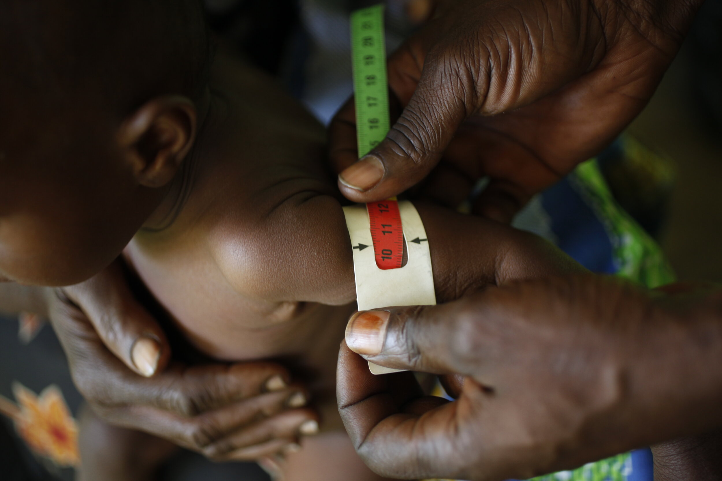  A baby has the circumference of the  middle of the upper left arm measured for signs of malnutrition. The red  (12cm)area is severe malnutrition, the yellow (13cm) is moderate malnutrition and the green (14cm) is good. Camp Vangu, Katanga, Democrati