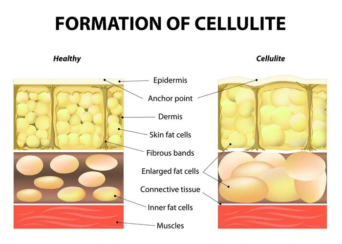 La cellulite, peut-on vraiment s'en débarrasser ?