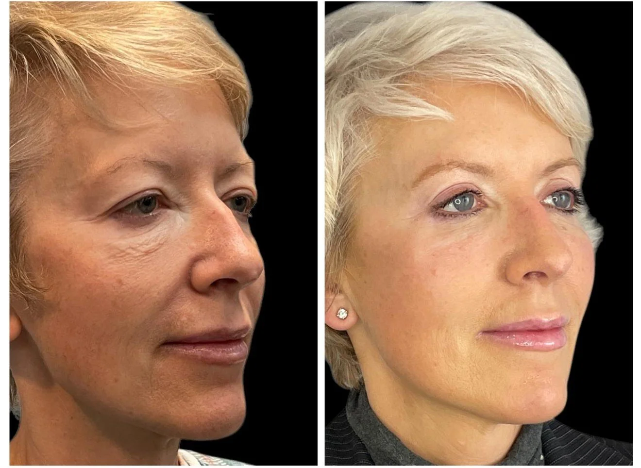 upper eyelift in torrance and redondo beach