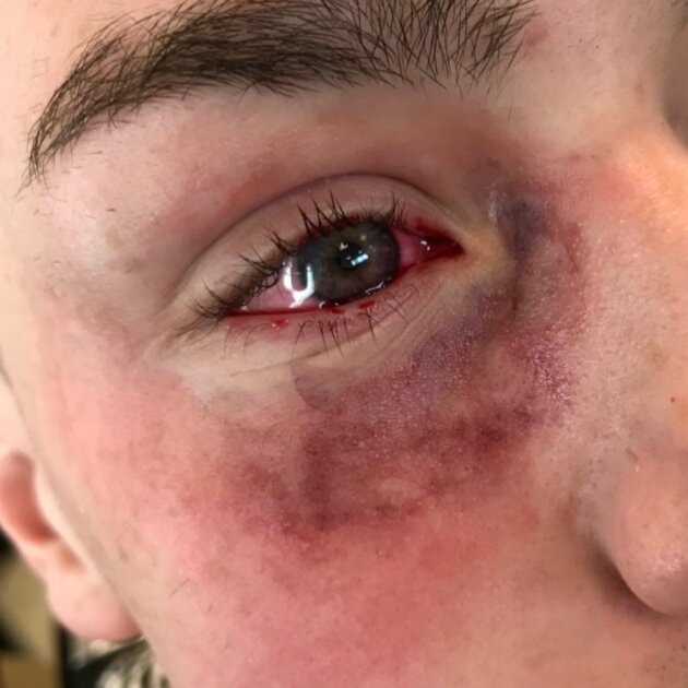 Fresh black eye, no appliances.
(May 2019)