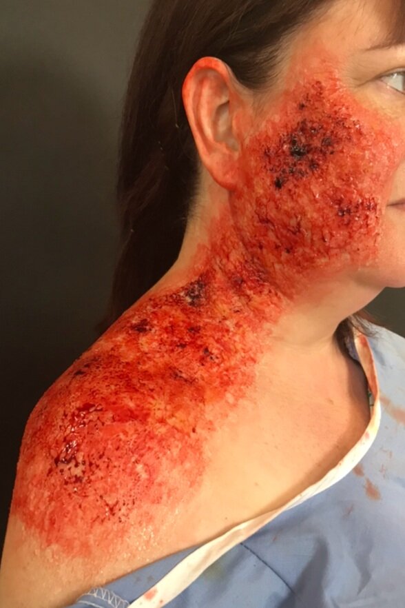 3rd Degree burns, no appliances.
(May 2019)
