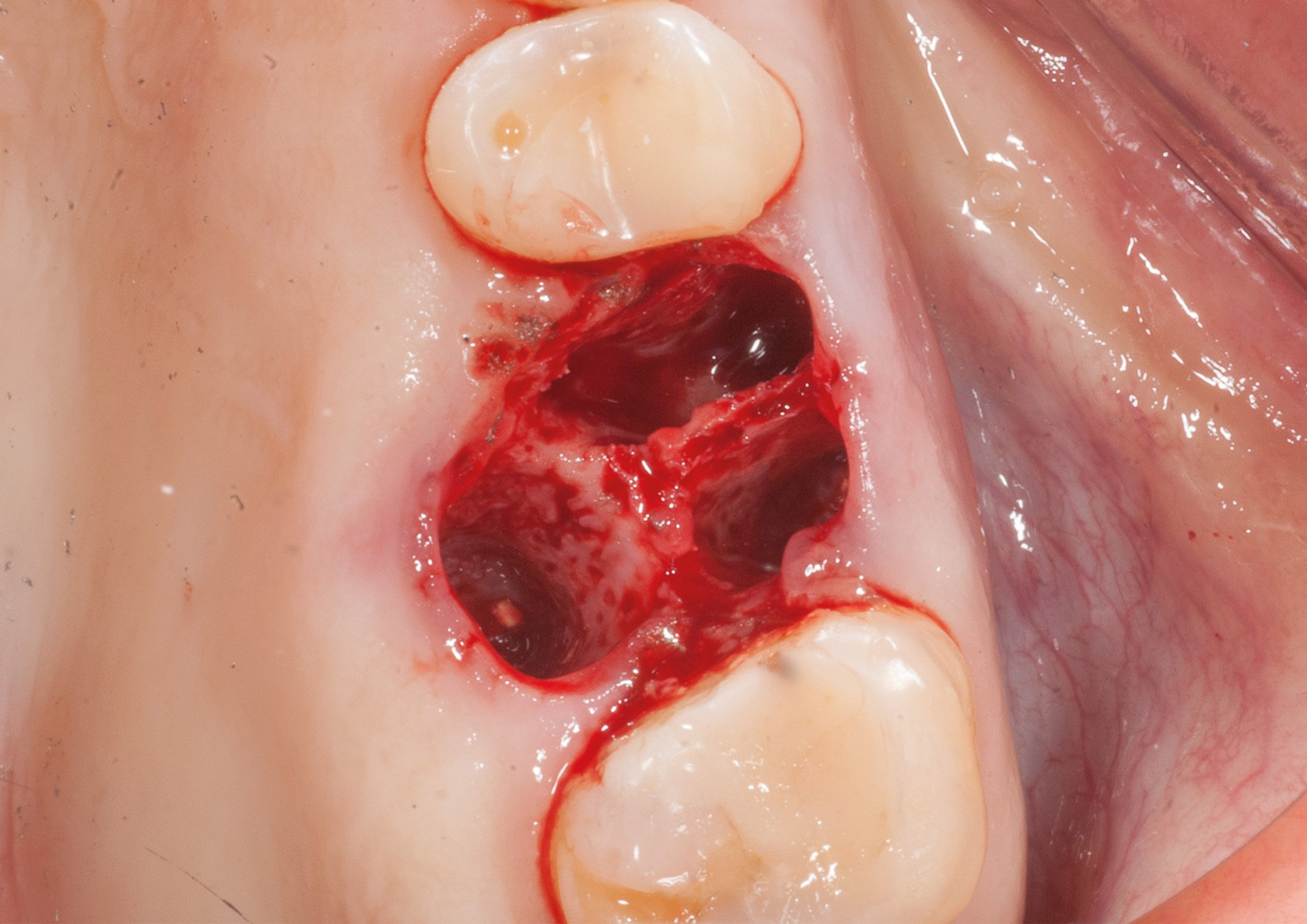 Post extraction. The alveolar sockets are degranulated.jpg