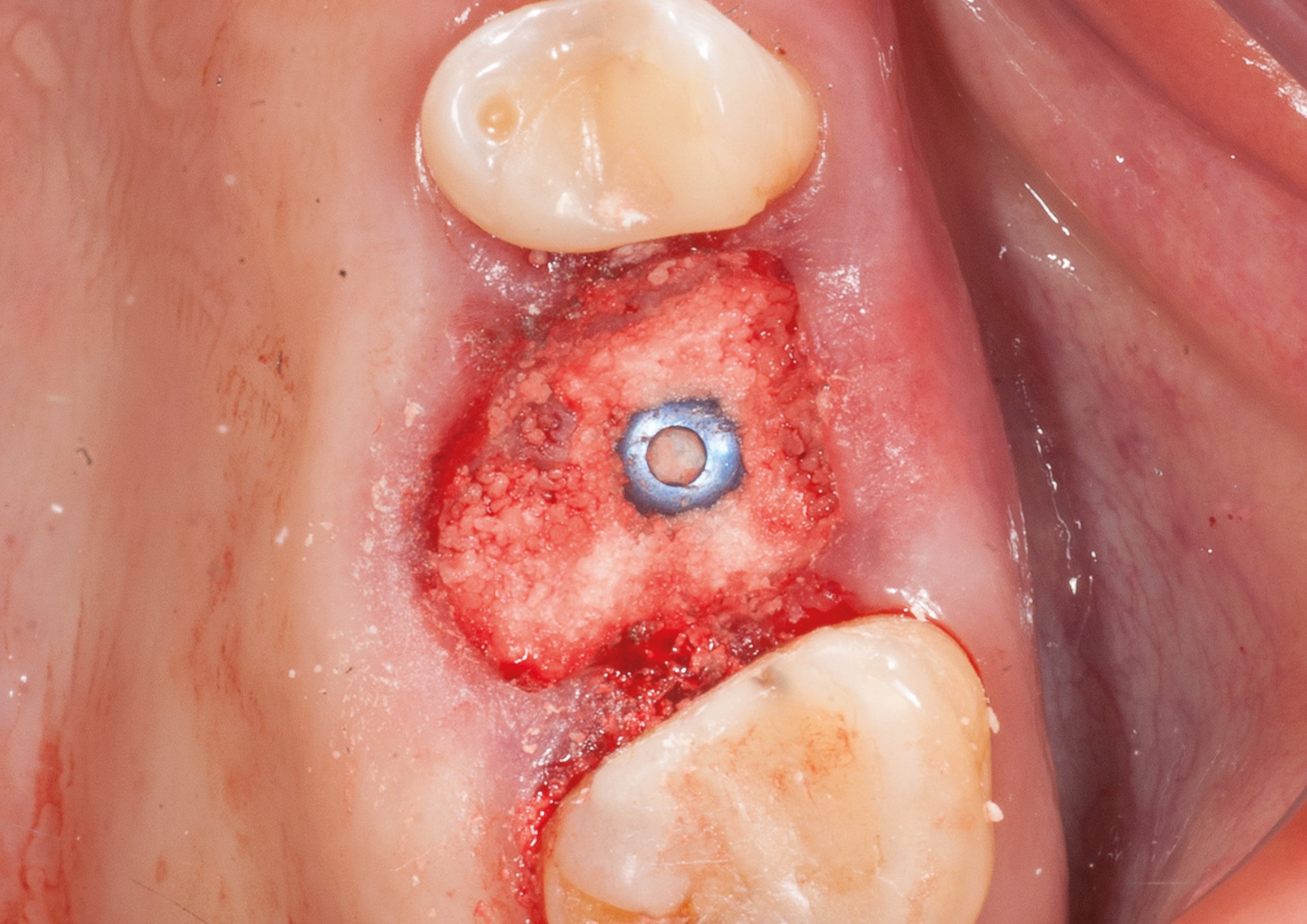 Socket grafted with EthOss bone graft material.jpg