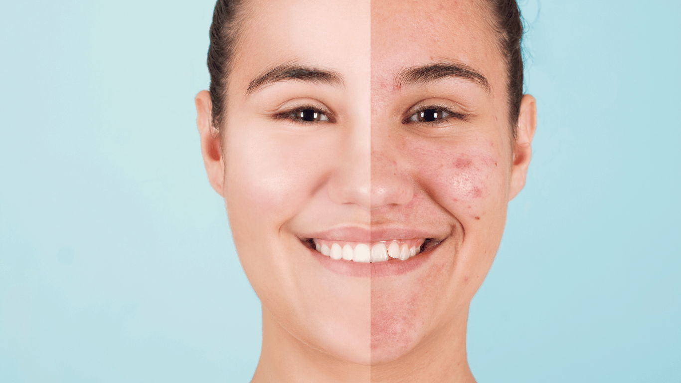 The 5 Most Common Reasons Why You Have Persistent Acne and How To ...
