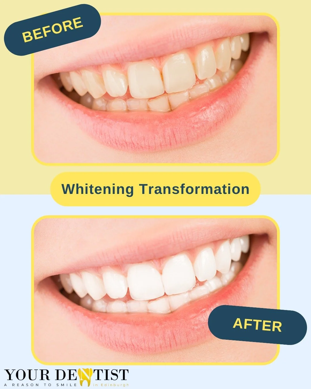 Whitening Transformation ✨
A brighter, more confident smile starts here. Our professional whitening treatments safely lift stains and reveal your natural shine — giving you a reason to smile every day.
See the difference for yourself at denti