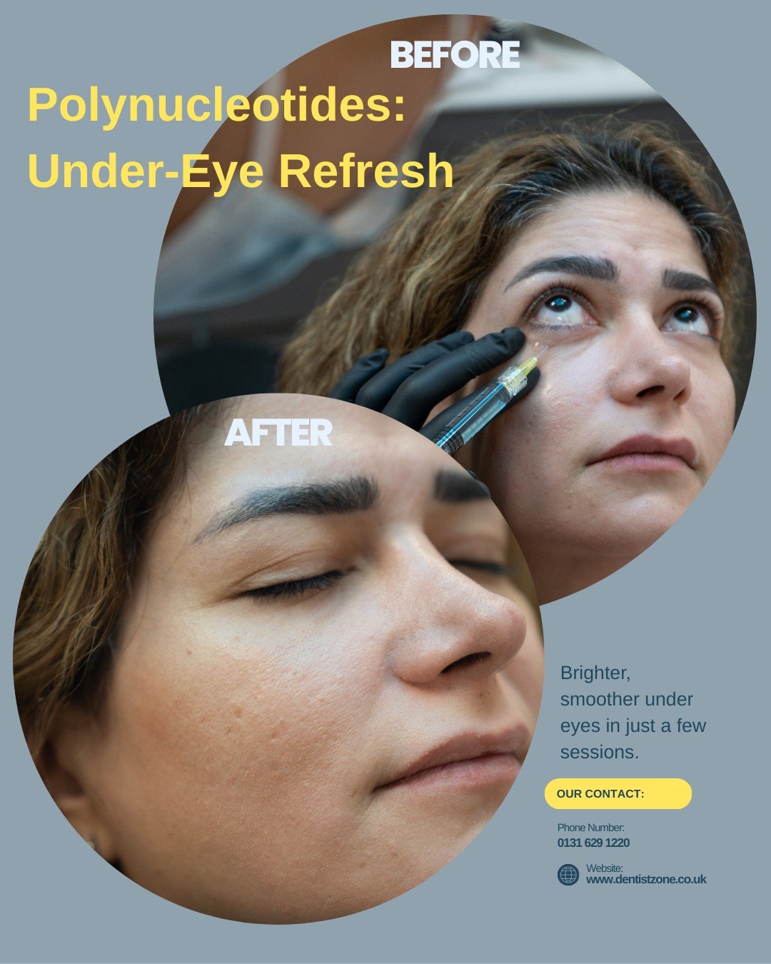 A brighter, more refreshed under-eye area achieved with polynucleotides ✨

This treatment helps improve skin quality from within, reducing dullness, fine lines, and hollowness while boosting hydration and collagen.

Results shown here were achieved i