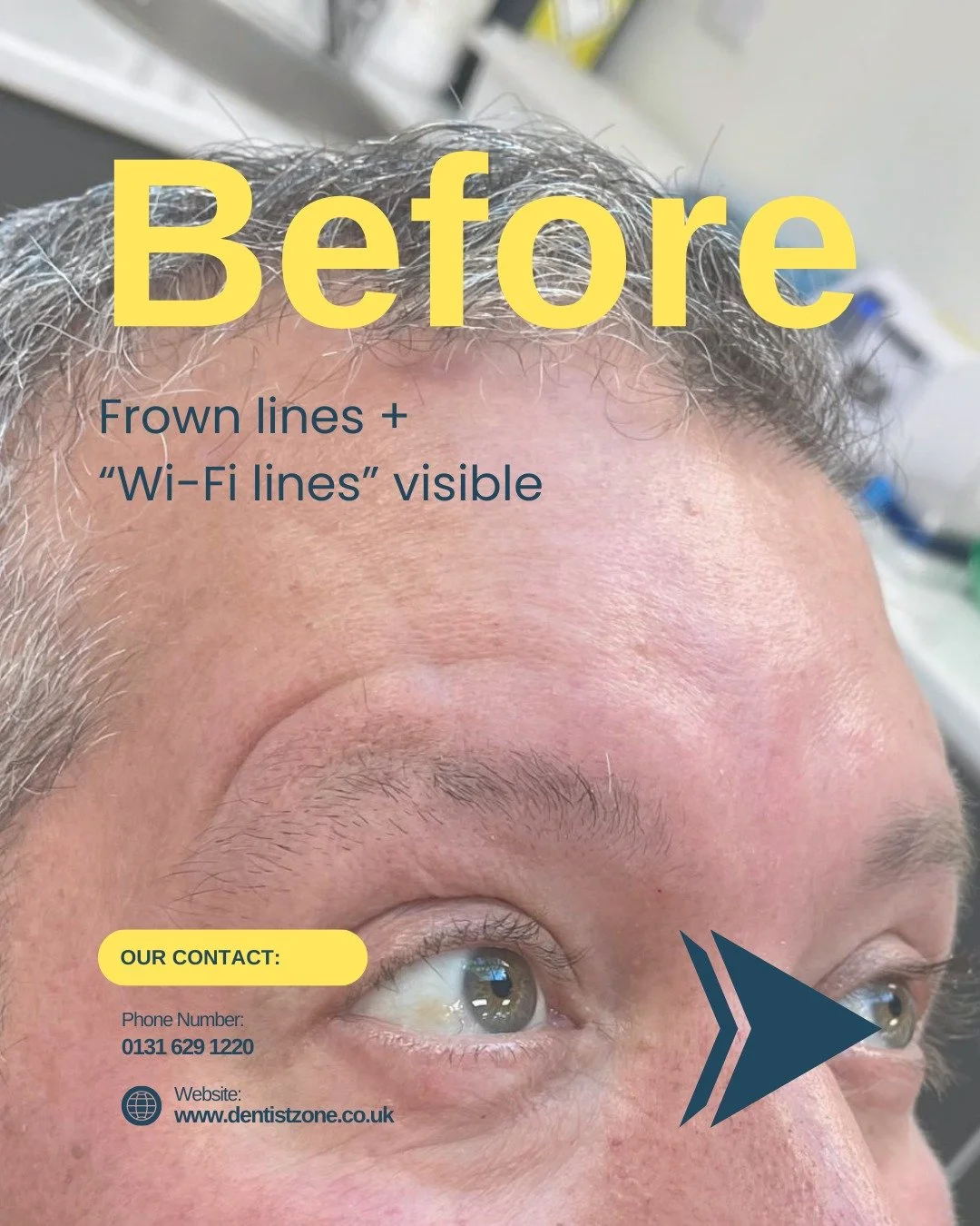 A subtle, natural refresh.
This treatment focused on softening both the frown lines and the curved &ldquo;Wi-Fi lines&rdquo; above the brows, while maintaining natural movement.

The result? A smoother, more relaxed look without losing expression.

T